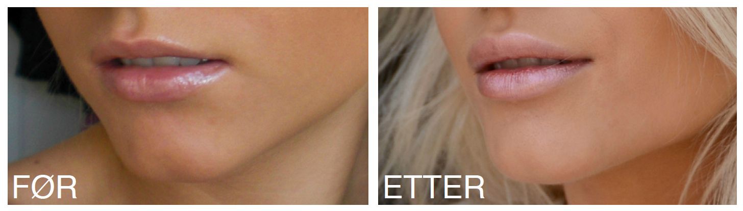  photo lips teosyal kiss fillers restylane2_zpsbttxfg2z.jpg