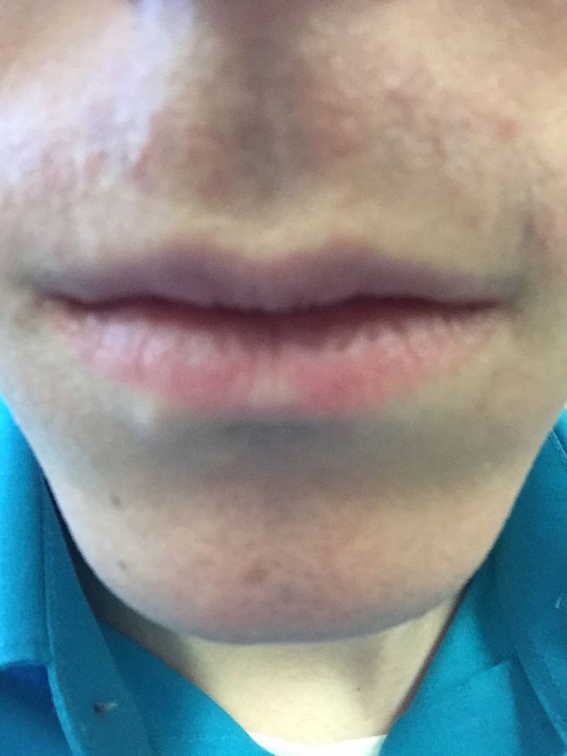 Upper lip shaving problem.